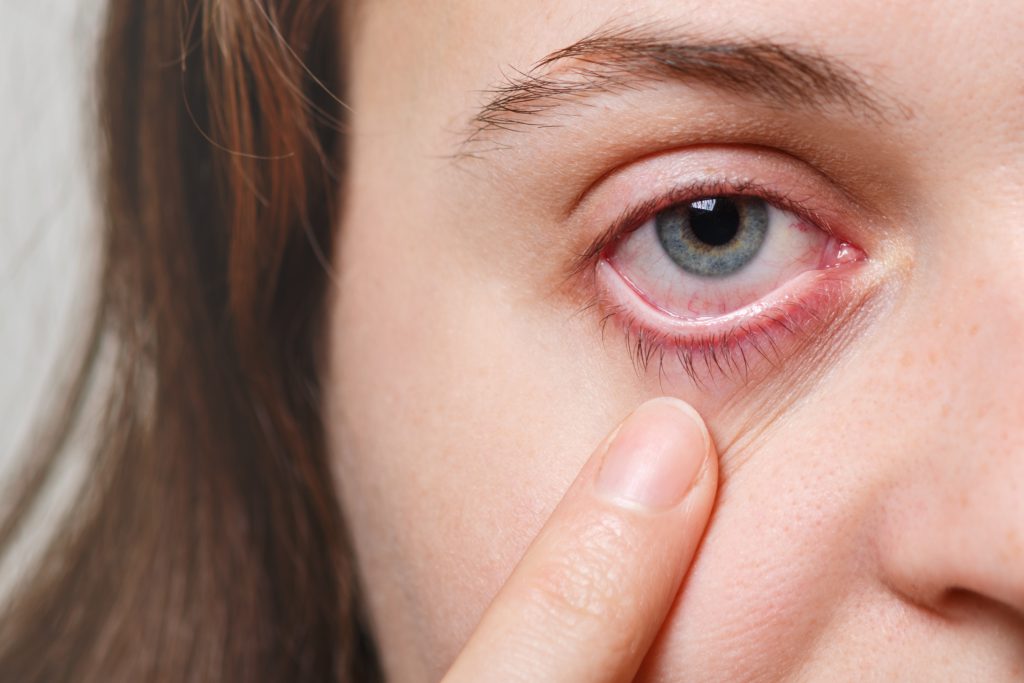 Medicine, health care and eyesight concept. Unrecognizable female shows her inflated red eye with blood capillary, has conjuctivitis. Woman with injured eye