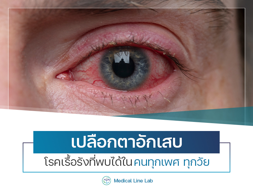 เปลือกตาอักเสบ โรคเรื้อรังที่พบได้ในคนทุกเพศ ทุกวัย