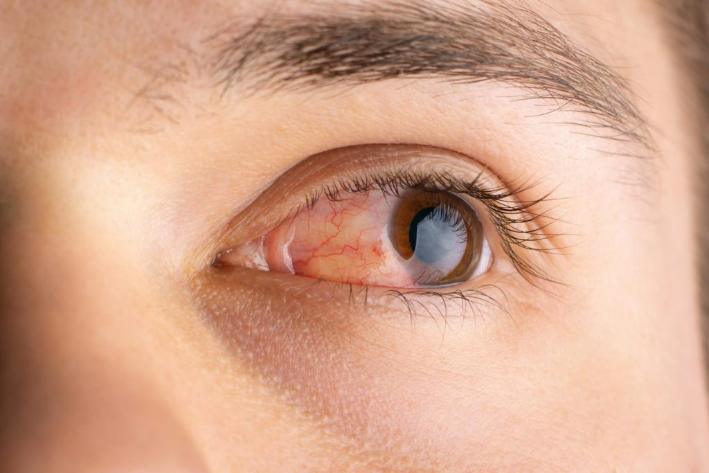 male-with-ill-eyes-concept-conjunctivitis