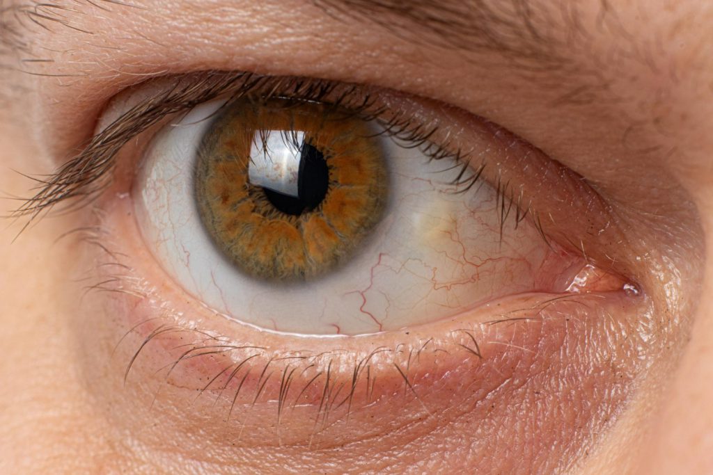 pinguecula-eyes-macro-photo-closeup-male-eye