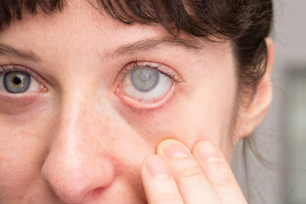 woman-with-cataract-eye-corneal-opacity
