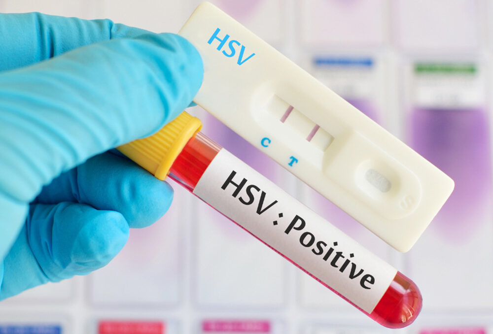ตรวจภูมิต่อเชื้อโรคเริมเพื่อดูการติดเชื้อ-herpes-simplex-virus-type12-Ab-IgM-long ตรวจภูมิต่อเชื้อโรคเริมเพื่อดูการติดเชื้อ-herpes-simplex-virus-type12-Ab-IgM-long