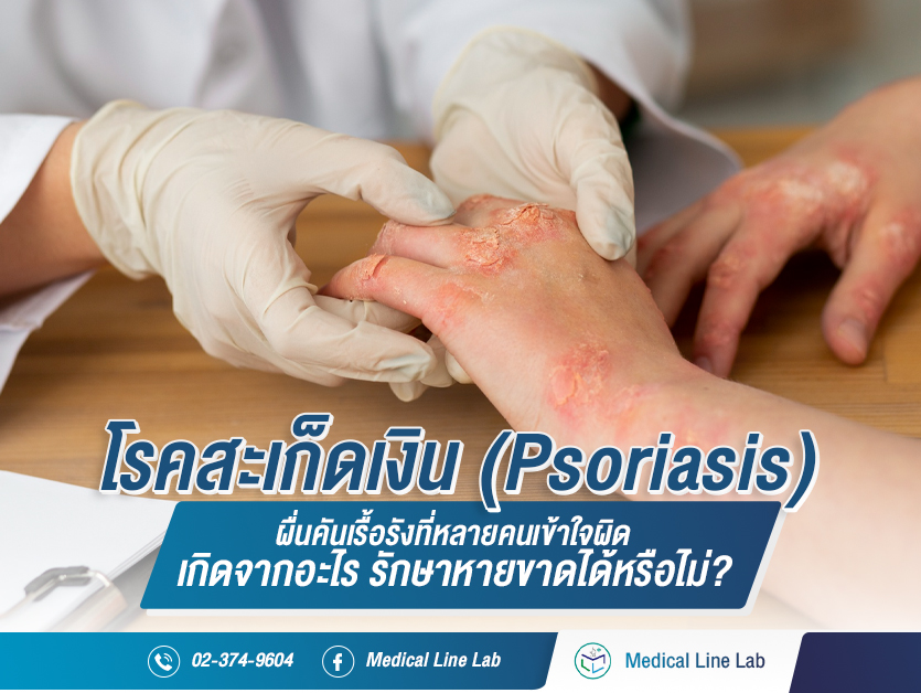 โรคสะเก็ดเงิน (Psoriasis) ผื่นคันเรื้อรังที่หลายคนเข้าใจผิด เกิดจากอะไร รักษาหายขาดได้หรือไม่?