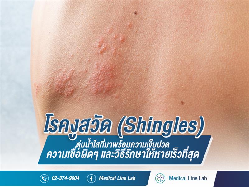 โรคงูสวัด (Shingles) ตุ่มน้ำใสที่มาพร้อมความเจ็บปวด ความเชื่อผิดๆ และวิธีรักษาให้หายเร็วที่สุด