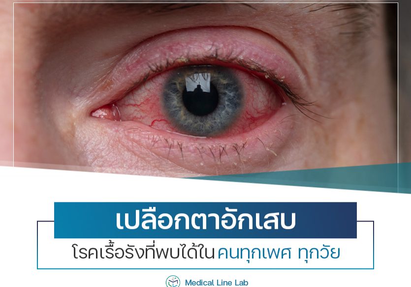 เปลือกตาอักเสบ โรคเรื้อรังที่พบได้ในคนทุกเพศ ทุกวัย